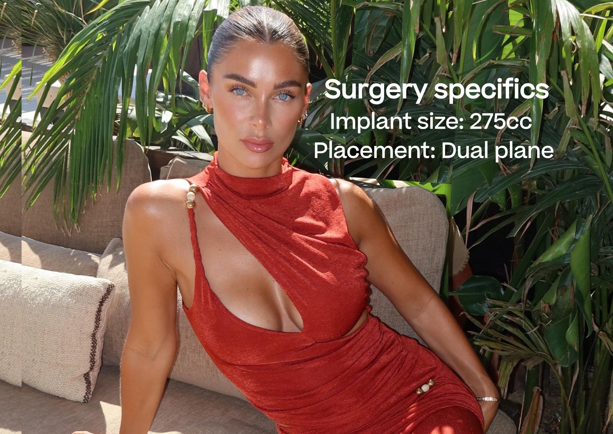 Cally Beech Breast Enlargement Patient 275cc Dual plane Cally Beech Breast Enlargement Patient 275cc Dual plane